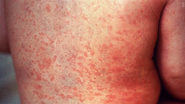measles3-S