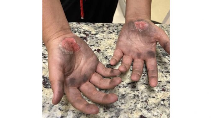 student burn
